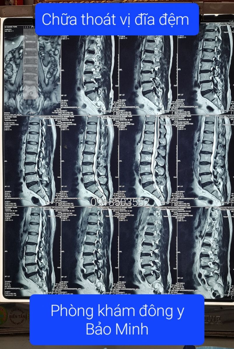 Chữa thoát vị đĩa đệm cho chị Huệ ở An Giang